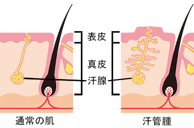 汗管腫のイメージ